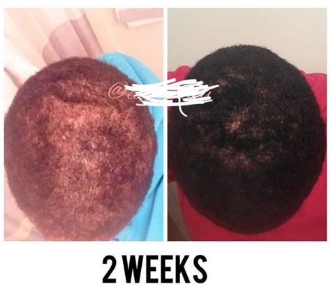 Tested Cure For Balding And Thining Hair Health Nigeria
