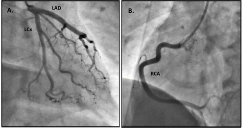 St Segment Elevation Myocardial Infarction With Normal Coronary