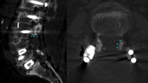 Sagittal And Axial Reconstructed Ct Scan With Arrows Showing The Site