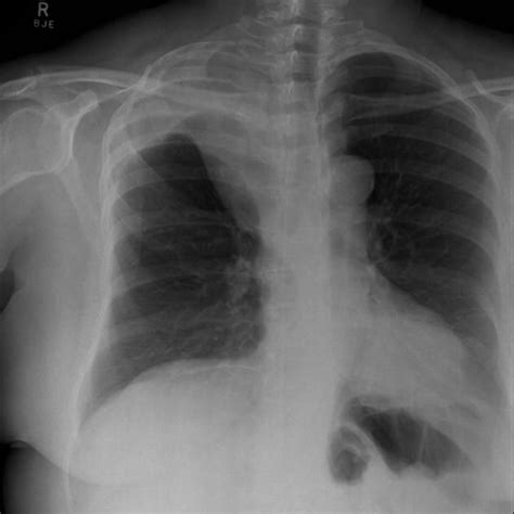 The Golden S Sign Is Seen On Both Pa Chest Radiographs And On Ct Scans