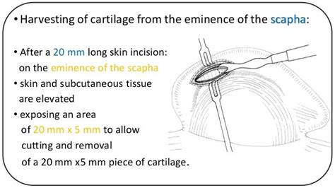 Technique Of Harvesting Cartilage Graft For Cartilage Tympanoplasty
