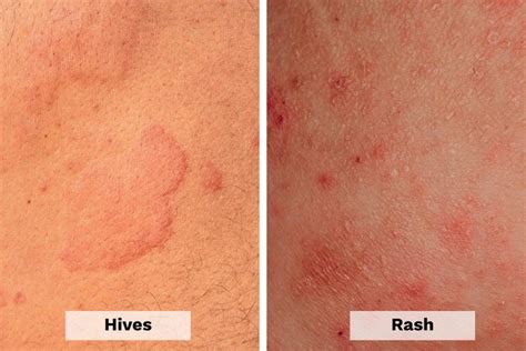 Hives Vs Rash Heres How To Tell The Difference The Healthy