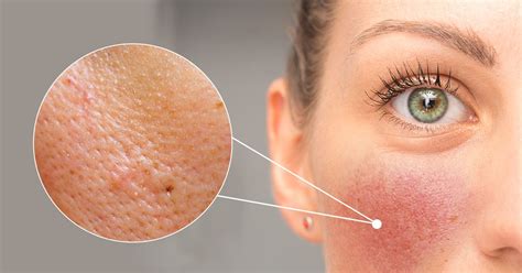 Understanding The Causes Of Orange Peel Skin