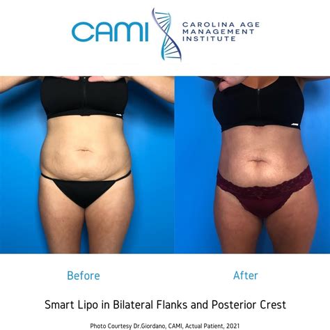 Laser Lipo Smart Lipo Before After Picture Gallery