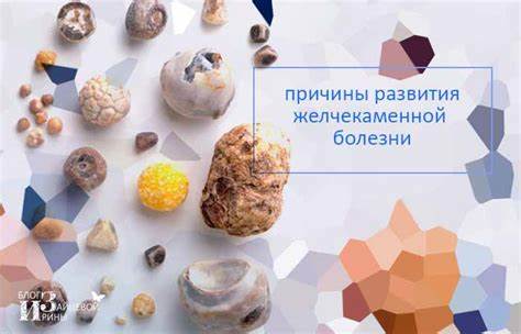 Желчекаменная болезнь. Симптомы, признаки и лечение. Диета Картинка - Желчекаменная болезнь. Симптомы, признаки и лечение. Диета