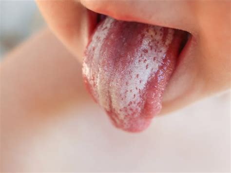 Warning Signs Your Tongue Could Be Sending About Your Health