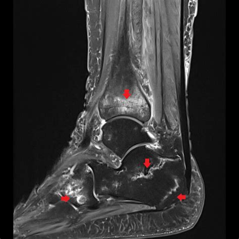 Mri Of The Right Foot Sagittal Proton Density Fatsaturated Sequence