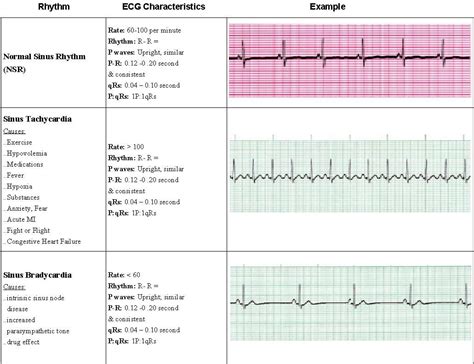 Acls Rhythms Pg 1 Of 7 Nursing Cheat Cardiac Nursing Nursing Study