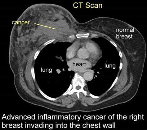 Breast Cancer Imaging