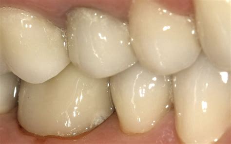 Direct Composite Crown With Luxacrown
