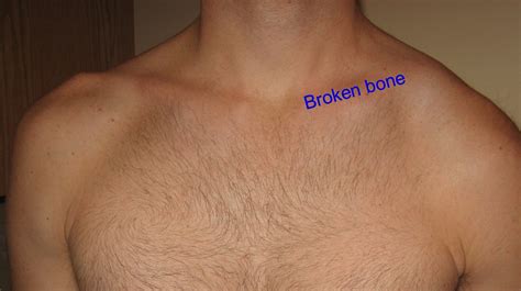 Fractured Collarbone