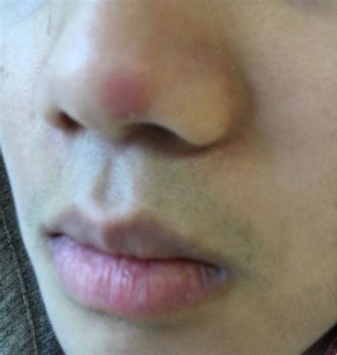 Skin Concern Red Bump On Nose Thats Tender To The Touch Skin