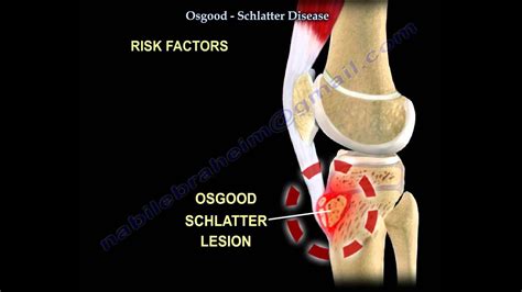 Osgood Schlatter Disease Everything You Need To Know Dr Nabil