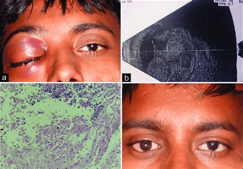 Right Eye Tense Proptosis Eyelid Edema And Ecchymoses Subconjunctival