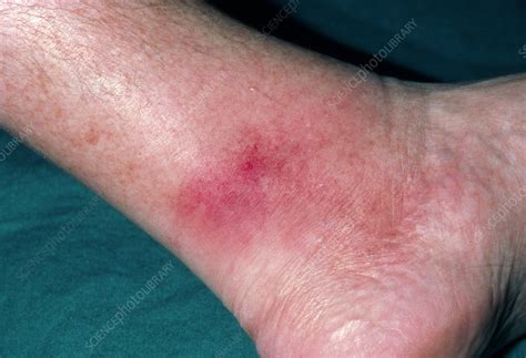 Cellulitis Affecting The Ankle Stock Image M1300228 Science Photo