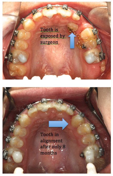 Impacted Canine Actual Patient Of Impressions Orthodontics