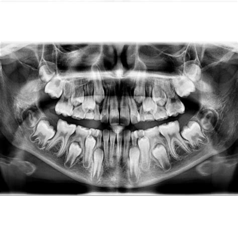 Radiografía Panorámica Ortopantomografía Gnux Dental