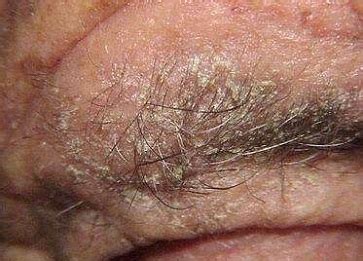 Scabies infestations can often resemble other skin conditions. Can I Take a Look of Norwegian Scabies Pictures? - HTQ