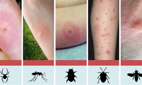 Discover How To Identify The Most Common Insect Bites Healthy Food