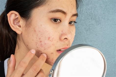 Heres What A Chemical Peel Can Do For Your Acne Scars Martha Viera
