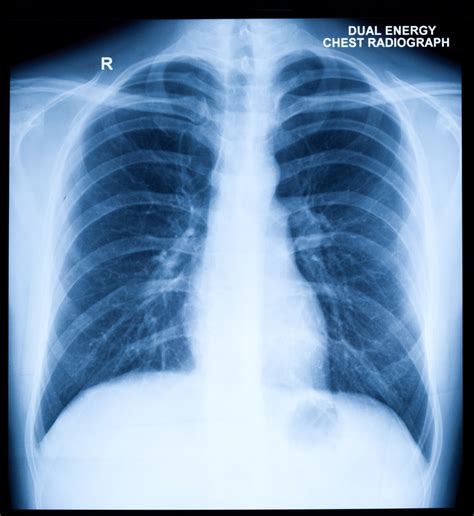 White Out Chest X Ray