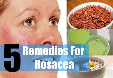 5 Home Remedies For Rosacea Natural Treatments And Cure For Rosacea