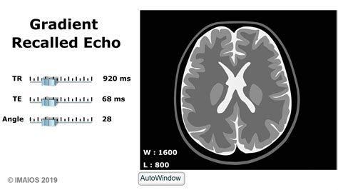 Mri Sequences Spoiled Gradient Echo Sequences E Mri