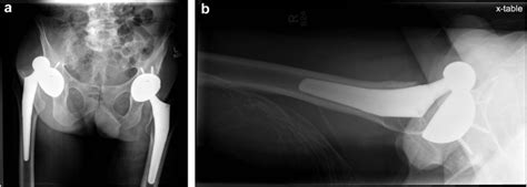 The Value Of The Direct Lateral Hip Radiograph In An Adult
