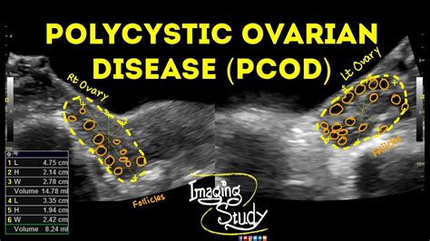 Polycystic Ovarian Disease Pcod Ultrasound Case Youtube