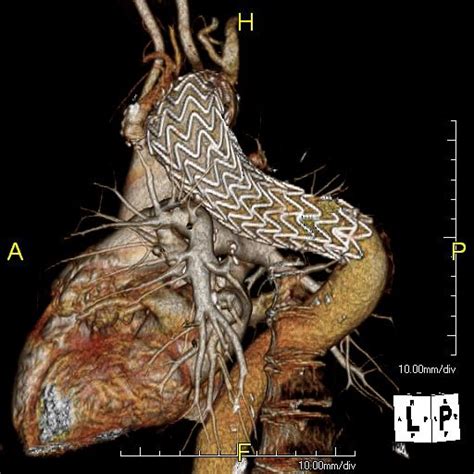Savs Endovascular Repair Of Ruptured Thoracic Aortic Aneurysm With