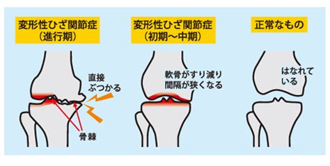 変形性膝関節症｜札幌市整体、カイロプラクティックではない ...