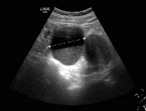 Rupture Of Ovarian Endometriotic Cyst Complicated With Endometriosis A Case Report