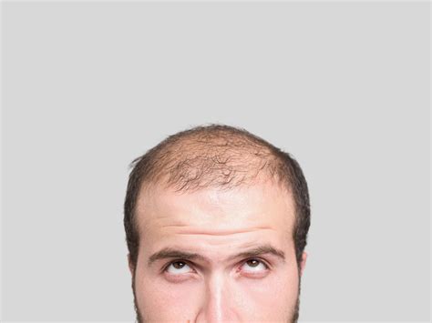 Hormone replacement therapy (hrt) involves taking female hormones, usually estrogen and do you have any experience with hormone replace therapy? How Hormone Replacement Therapy Can Stop and Reverse Hair ...