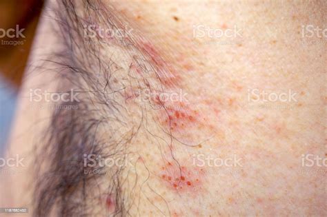 Extreme Closeup Photography Of The Atocpic Dermatitis Symptoms Stock