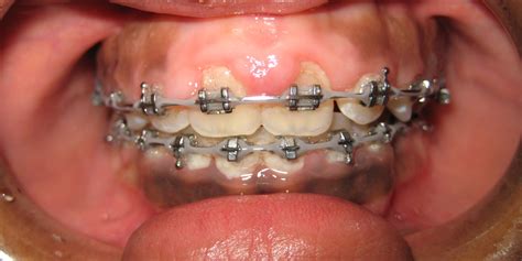 Swollen Gums With Braces