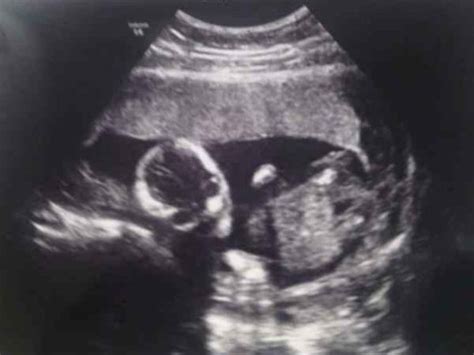 Check spelling or type a new query. Gambar Hasil Usg Janin Perempuan : Usg Bayi Perempuan ...