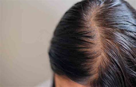 Types Of Dandruff And How To Prevent Them Head Shoulders In Vlrengbr