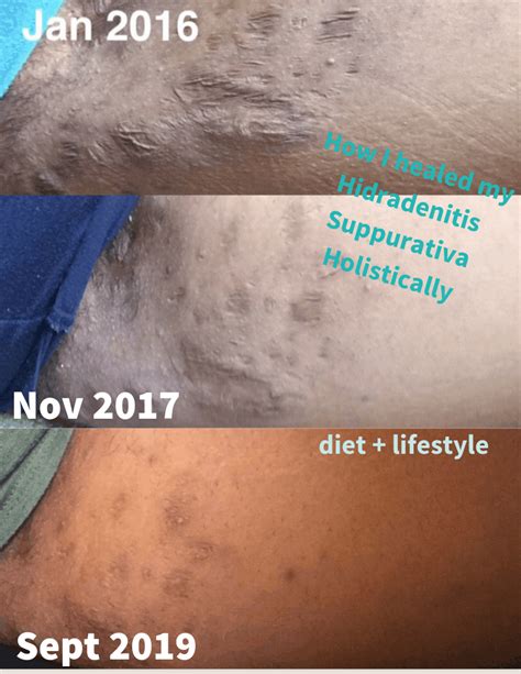 How To Heal Hidradenitis Suppurativa With Diet And Lifestyle This Auto