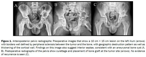 Primary Aneurysmal Bone Cyst Of The Ilium In A Pediatric Patient Case