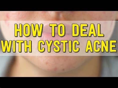 We all know the benefits of mint as a toner, but mint leaves are great when applied directly, they provide a nice refreshing feeling. 7 Cystic Acne Home Remedies that Really Work - YouTube ...