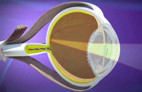 Cataract Surgery Lens Options Eye Center Of Texas