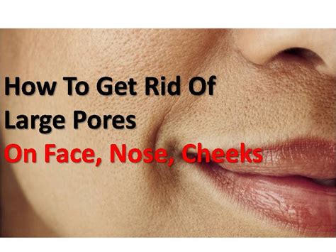 How To Get Rid Of Large Pores At Home On Face Nose Cheeks Youtube