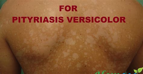 Pityriasis Versicolor Causes