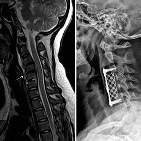 Preoperative Cervical Spine Magnetic Resonance Image Of A Patient With