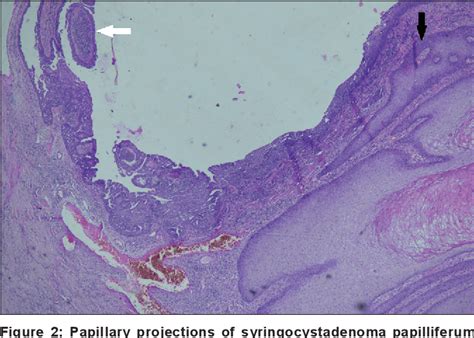 Figure 2 From Well Differentiated Squamous Cell Carcinoma Arising In