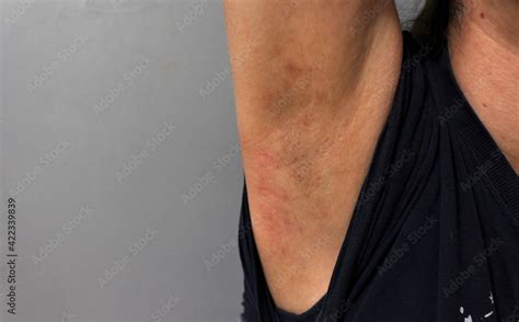 A Woman With Rash On Her Underarms Rash On Armpit Due To Deodorant
