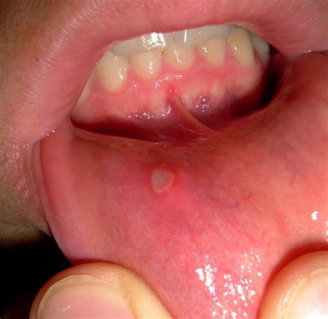 Aphthous Stomatitis Definition Types Causes And Treatment