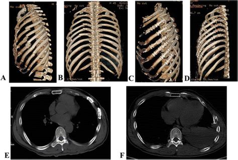 One Typical Case Of Rib Fracture Before And After Surgical Fixation