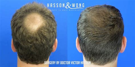 Hair Transplant Crown Area A Complete Guide To Crown Hair Transplants