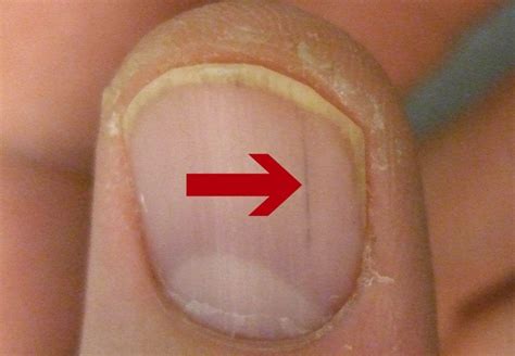 What Causes Red Streaks Under Nails Fingernail Health Nail Health